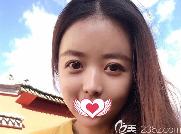 脂肪填充15天轮廓清晰 脂肪填充15天轮廓清晰