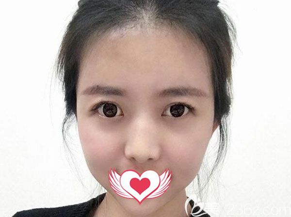 脂肪填充全脸30天面部脂肪已经稳定 脂肪填充全脸30天面部脂肪已经稳定