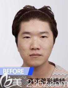 韩国然之美整形外科医院双眼皮+隆鼻+下巴整形案例 韩国然之美整形外科医院双眼皮+隆鼻+下巴整形案例