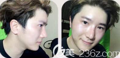 韩国然之美整形医院双眼皮+隆鼻+垫下巴案例术后15天效果图 韩国然之美整形医院双眼皮+隆鼻+垫下巴案例术后15天效果图