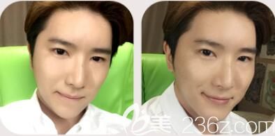 韩国哪家整形医院好?韩国然之美眼鼻+下巴整表案例 韩国哪家整形医院好?韩国然之美眼鼻+下巴整表案例