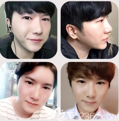 韩国做鼻子哪里好?然之美鼻综合隆鼻术后真实恢复效果 韩国做鼻子哪里好?然之美鼻综合隆鼻术后真实恢复效果