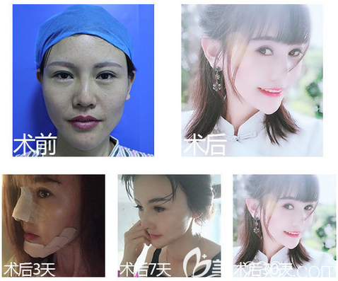 佛山华美雷朝勇院长隆鼻案例 佛山华美雷朝勇院长隆鼻案例