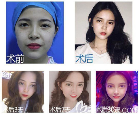 佛山华美雷朝勇医生双眼皮手术案例 佛山华美雷朝勇医生双眼皮手术案例