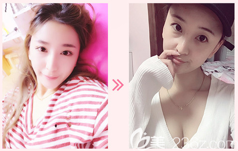 佛山华美雷朝勇隆胸案例 佛山华美雷朝勇隆胸案例