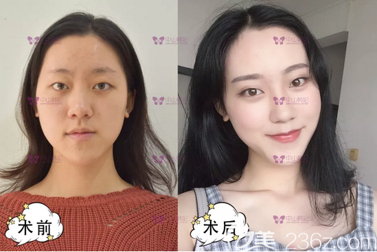 中山韩妃李光琴医生双眼皮案例 中山韩妃李光琴医生双眼皮案例