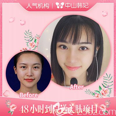中山韩妃李光琴双眼皮失败修复案例 中山韩妃李光琴双眼皮失败修复案例