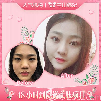 中山韩妃李光琴双眼皮和隆鼻修复案例 中山韩妃李光琴双眼皮和隆鼻修复案例