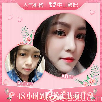 中山韩妃李光琴医生肋软骨隆鼻案例 中山韩妃李光琴医生肋软骨隆鼻案例