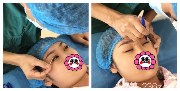 张悦迪医生设计双眼皮方案 张悦迪医生设计双眼皮方案