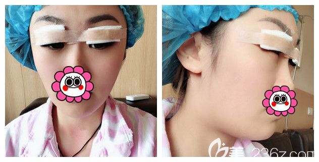 刚做完韩式切开+开眼角+祛皮/祛脂术后即刻 刚做完韩式切开+开眼角+祛皮/祛脂术后即刻