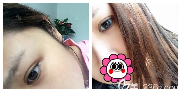 眼部综合整形术后一周恢复效果 眼部综合整形术后一周恢复效果