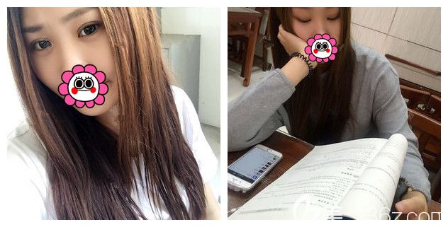 找张悦迪医生做眼综合术后一个月效果 找张悦迪医生做眼综合术后一个月效果