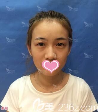 在长沙星雅整形医院做全切双眼皮术前照 在长沙星雅整形医院做全切双眼皮术前照