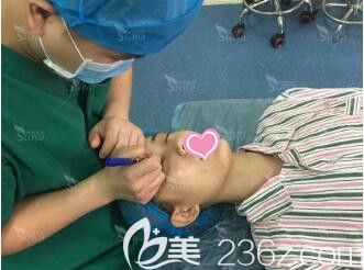 割双眼皮术前划线设计局麻 割双眼皮术前划线设计局麻