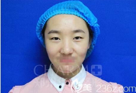 郑州医德佳员工亲身体验阿尔法美眼术2.0