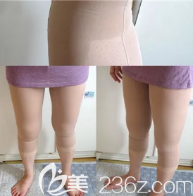 全身吸脂术前照片 全身吸脂术前照片