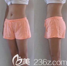 潍坊华美做全身吸脂手术挺好的，我做完腰腹、大腿和手臂恢复的也快