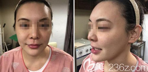 在韩国ARTLINE皮肤科做埋线提升前 在韩国ARTLINE皮肤科做埋线提升前