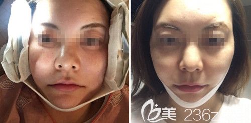 在韩国ARTLINE皮肤科做埋线提升手术当天 在韩国ARTLINE皮肤科做埋线提升手术当天