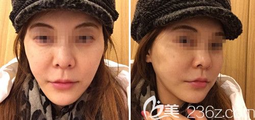 在韩国ARTLINE皮肤科做埋线提升术后3天 在韩国ARTLINE皮肤科做埋线提升术后3天