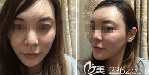 在韩国ARTLINE皮肤科做埋线提升后10天 在韩国ARTLINE皮肤科做埋线提升后10天