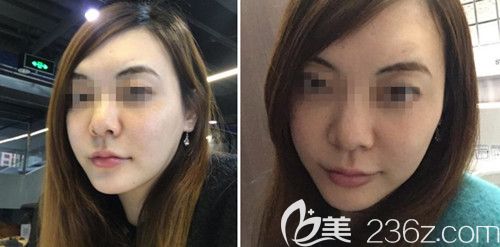 在韩国ARTLINE皮肤科做埋线提升后1个月 在韩国ARTLINE皮肤科做埋线提升后1个月