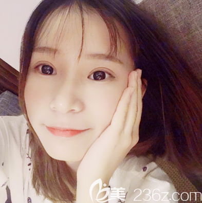 来看我在汕头曙光做的双眼皮怎么样