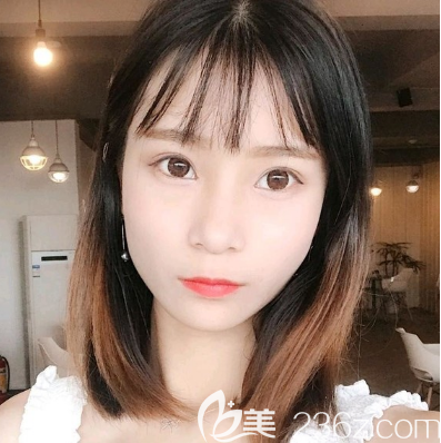 花一万多元在汕头曙光做的全切双眼皮效果