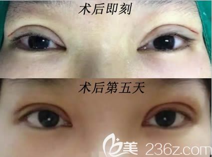长春姬安娣做眼综合术后即刻照和第五天照