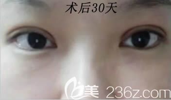 长春姬安娣整形双眼皮术后30天照