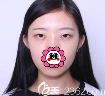 在北京壹加壹做眼综合之前样子 在北京壹加壹做眼综合之前样子