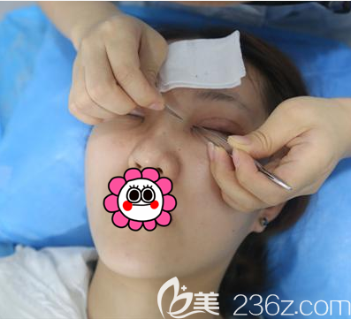 丁洪如医生给我做眼综合设计照 丁洪如医生给我做眼综合设计照