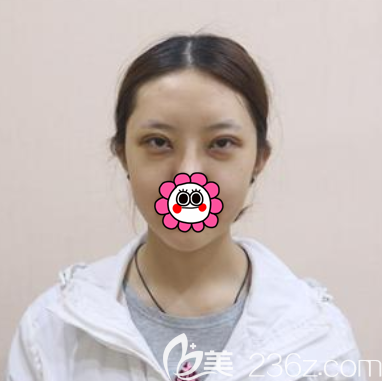 在北京壹加壹做眼综合术后即刻样子 在北京壹加壹做眼综合术后即刻样子