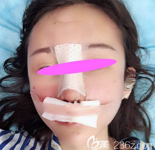 去上饶尚美整形医院让张维华主任做膨体+耳软骨隆鼻术后第2天效果