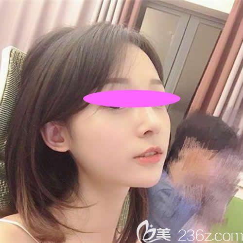 去上饶尚美整形医院让张维华主任做膨体+耳软骨隆鼻术后一个半月效果