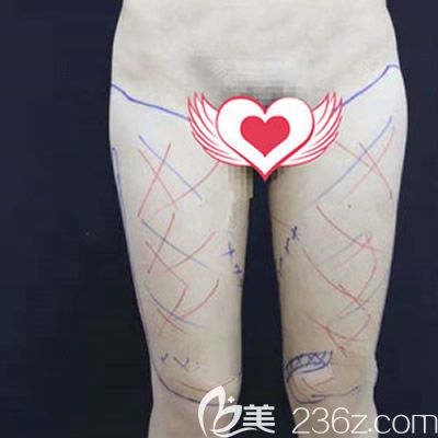 赣州华美医院的牛先翠给我做大腿环形吸脂术前设计划线
