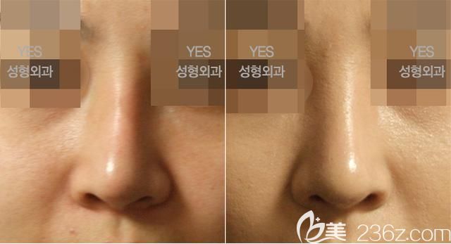 韩国yes整形外科医院隆鼻案例 韩国yes整形外科医院隆鼻案例