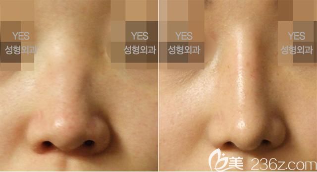 韩国yes隆鼻案例 韩国yes隆鼻案例