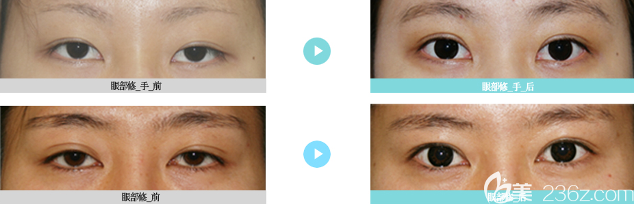 韩国YES整形外科双眼皮案例 韩国YES整形外科双眼皮案例