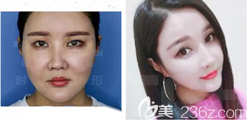 重庆时光做面部线雕效果怎么样 重庆时光做面部线雕效果怎么样