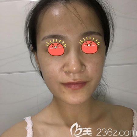 绍兴艺美整形做硅胶隆鼻术前 绍兴艺美整形做硅胶隆鼻术前