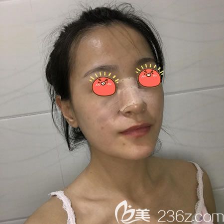 绍兴艺美刚做完假体隆鼻的<span style= 绍兴艺美刚做完假体隆鼻的<span style=