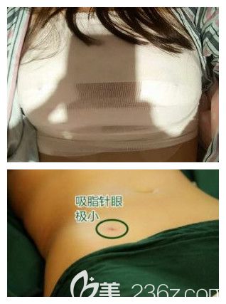 我在南宁华美做腰腹部吸脂加隆胸术后第2天