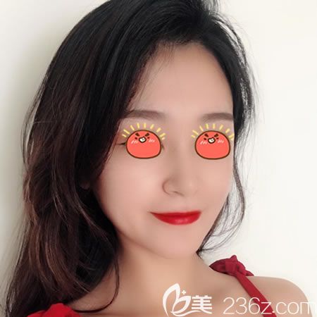 过完年在绍兴艺美做的硅胶假体隆鼻手术,现在把恢复3个月效果和价格分享给大家