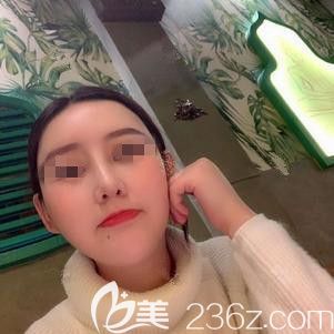 在保定蓝山做鼻综合术后20天鼻子变高挺 在保定蓝山做鼻综合术后20天鼻子变高挺