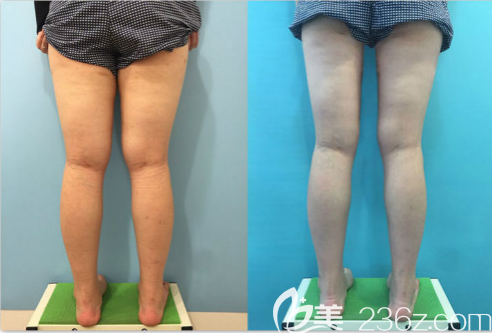韩国G皮肤<!--<i data=20240703-sp></i>-->腿吸脂塑形手术案例效果对比图