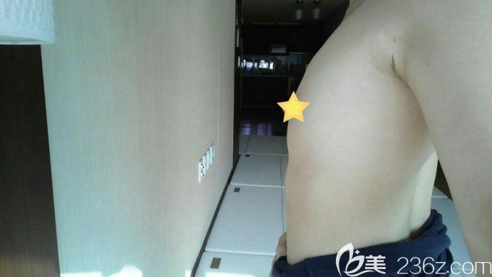 韩国jk隆胸真人案例 韩国jk隆胸真人案例