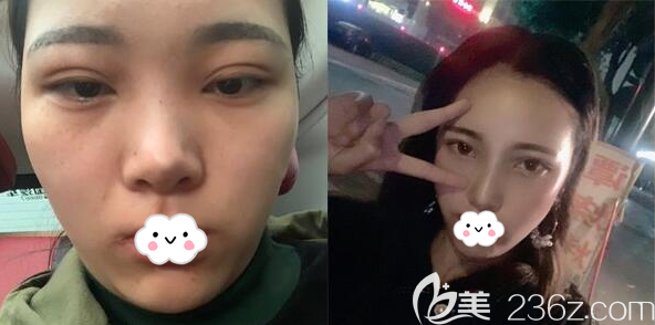 成都成美李静鼻综合术后15天对比照片