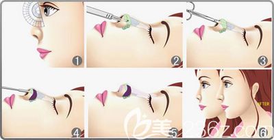 听杨伟医师说隆鼻手术的切口在哪 听杨伟医师说隆鼻手术的切口在哪